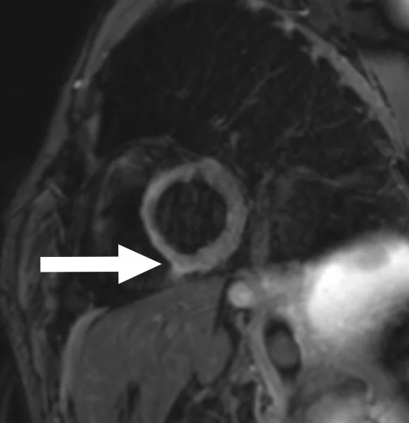A patient, who was diagnosed with Stage IV Lung Adenocarcinoma