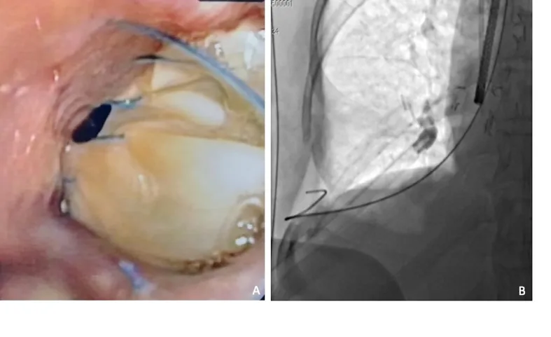 A patient, who was diagnosed with Lung Adenocarcinoma