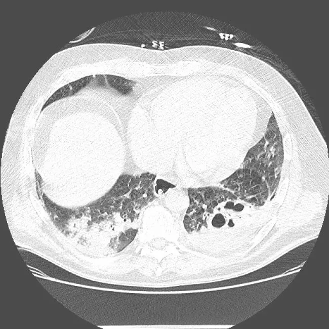 A patient, who was diagnosed with Non-Small Cell Lung Cancer
