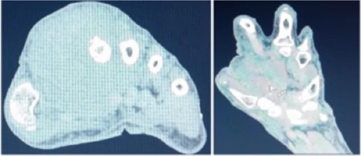 A patient, who was diagnosed with Gastric Cancer