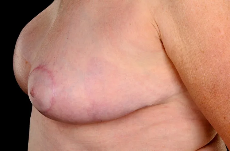A patient, who was diagnosed with Breast Cancer