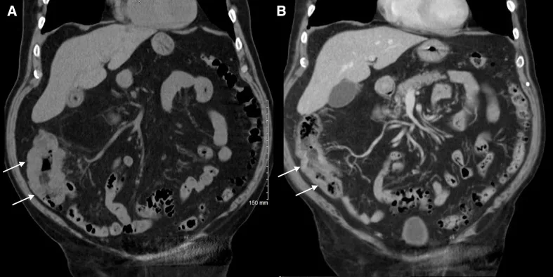 A patient, who was diagnosed with Colorectal Cancer