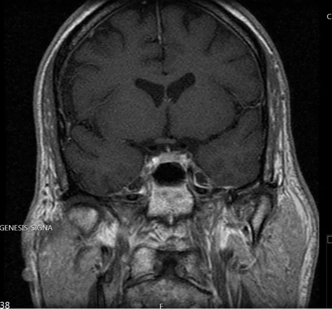A patient, who was diagnosed with Stage IV Non-Small Cell Lung Cancer