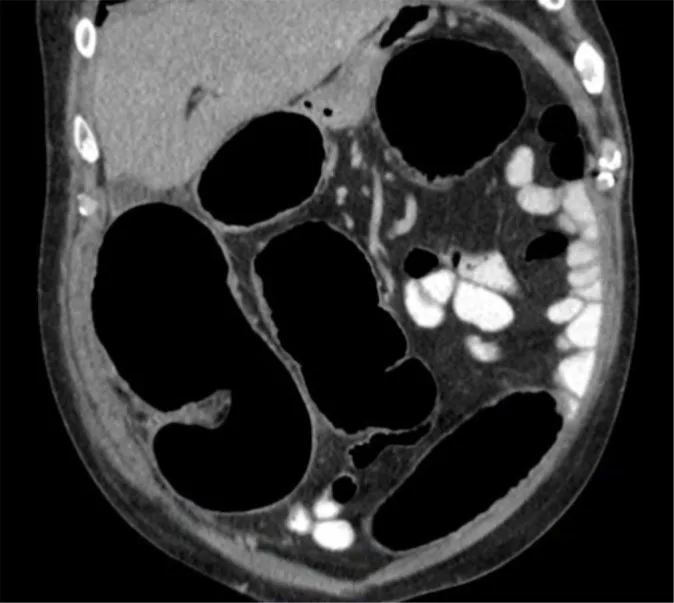 A patient, who was diagnosed with Stage IV Colorectal Cancer