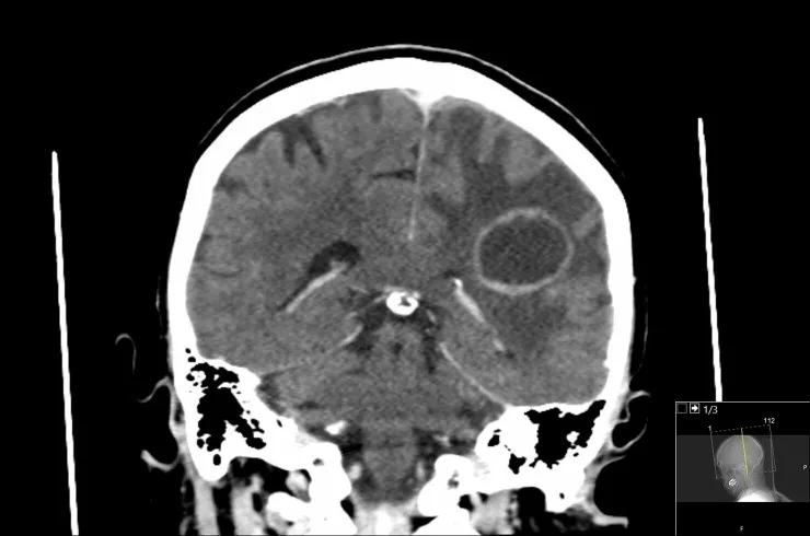 A patient, who was diagnosed with Ovarian Cancer