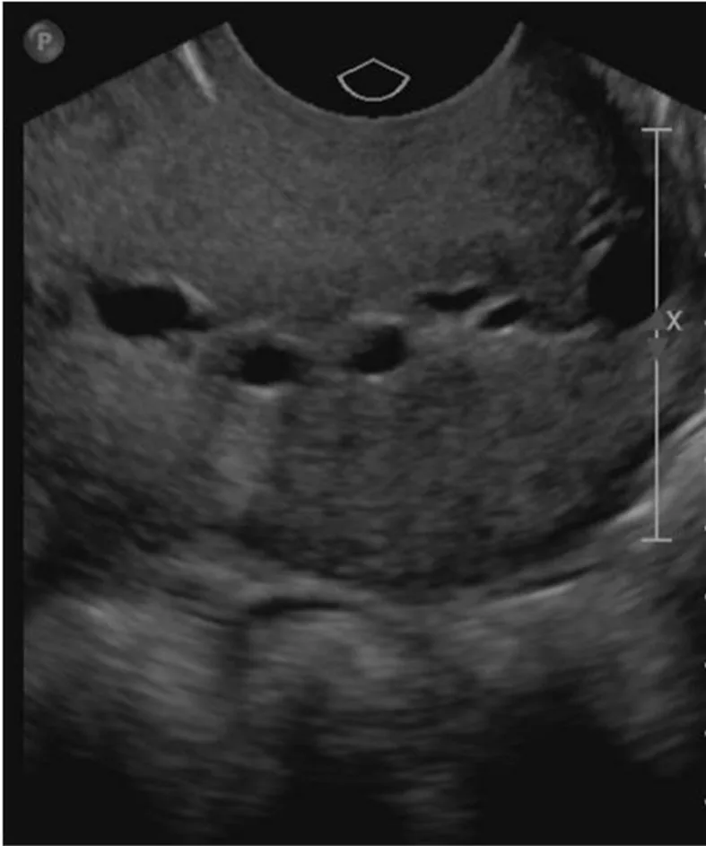 A patient, who was diagnosed with Breast Cancer
