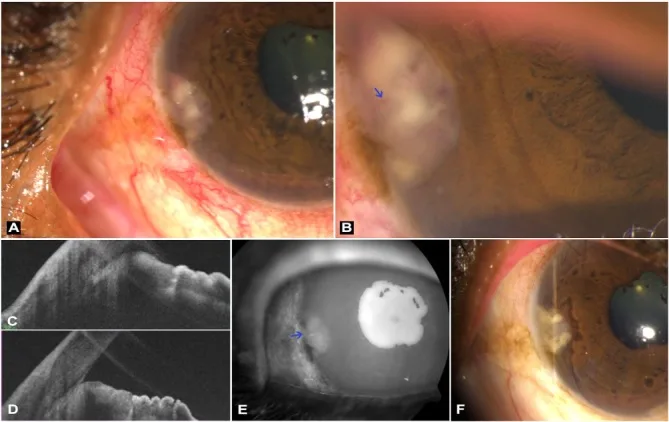 A patient, who was diagnosed with Stage IV Lung Squamous Cell Carcinoma