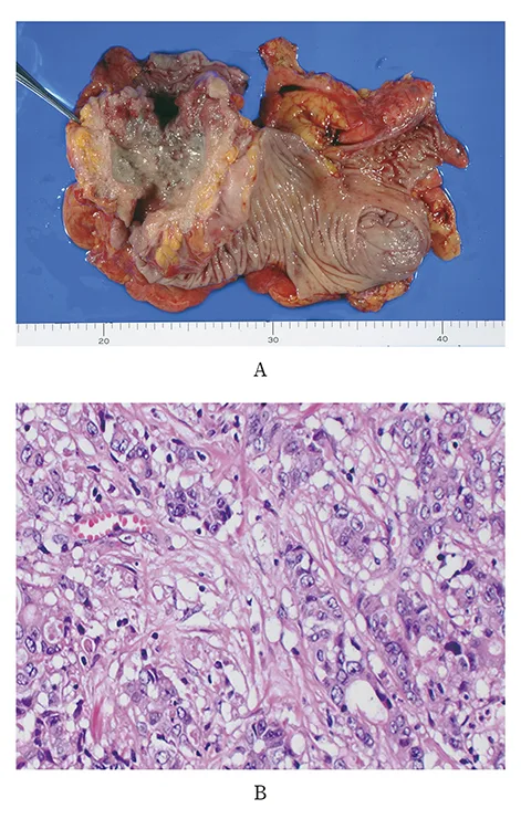 A patient, who was diagnosed with Stage IV Colorectal Adenocarcinoma