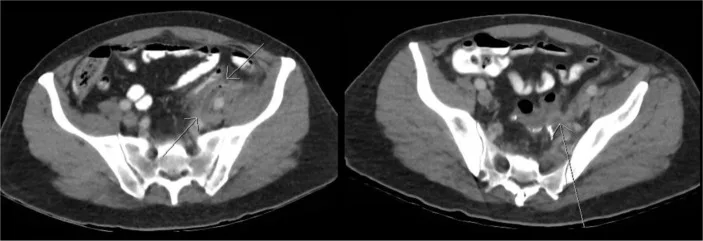 A patient, who was diagnosed with Colorectal Cancer