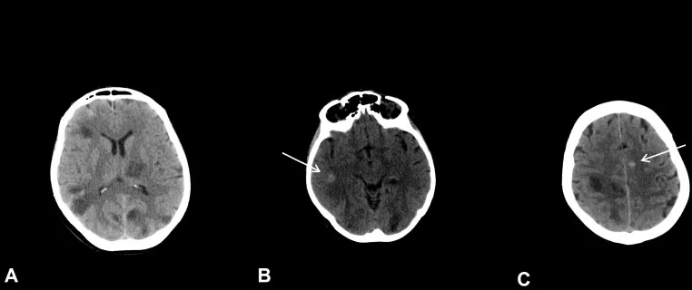 A patient, who was diagnosed with Stage IV Lung Cancer