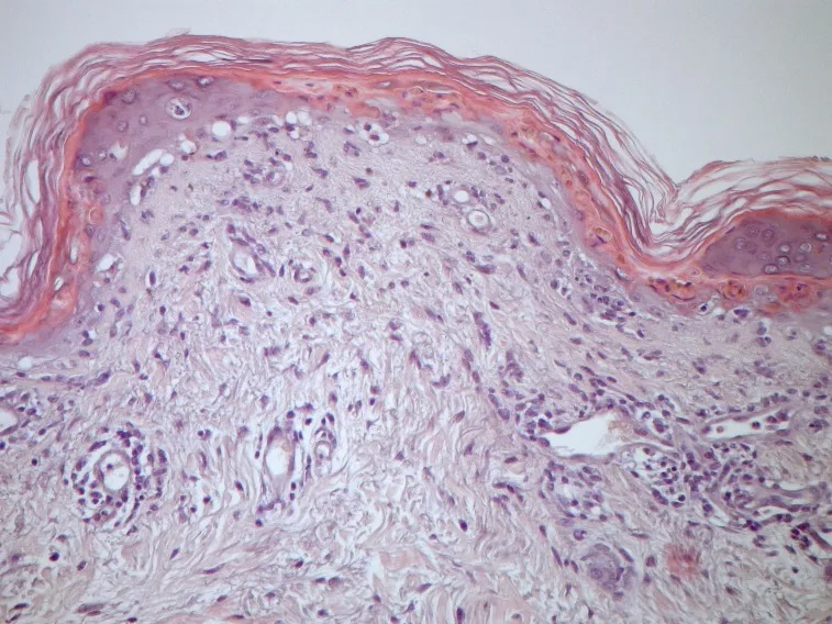 A patient, who was diagnosed with Stage I Small Cell Lung Cancer