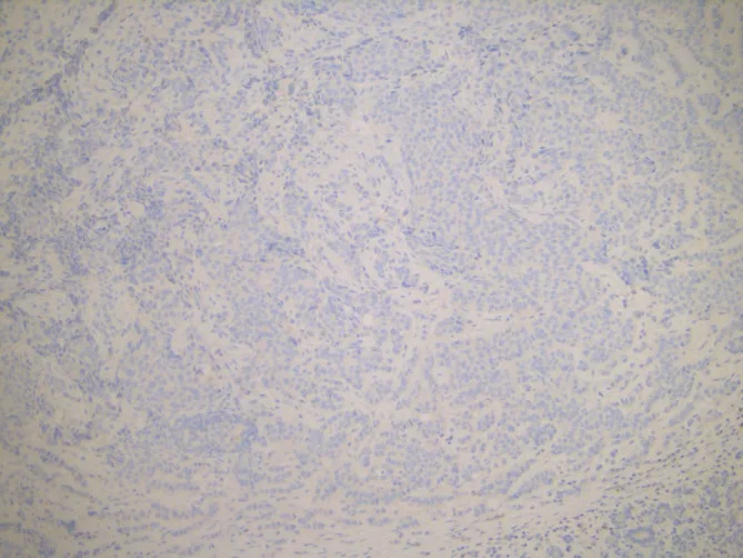 A patient, who was diagnosed with Stage IV Invasive Ductal Carcinoma