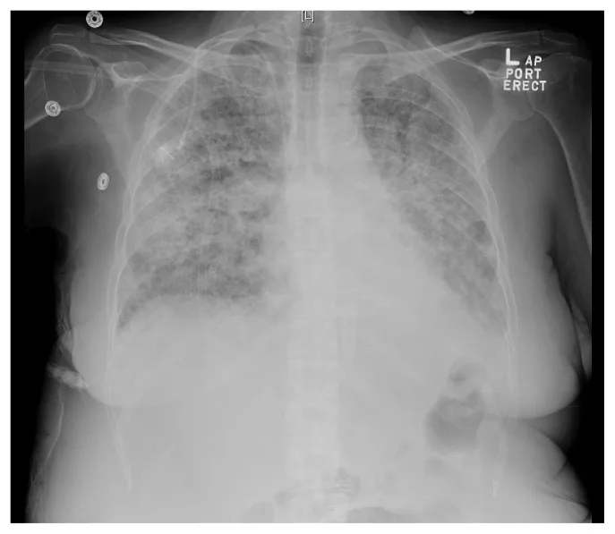 A patient, who was diagnosed with Stage IV Colorectal Adenocarcinoma