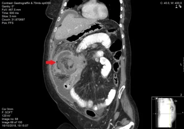 A patient, who was diagnosed with Colorectal Adenocarcinoma