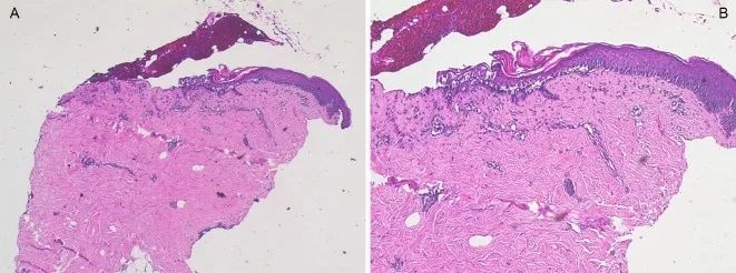 A patient, who was diagnosed with Colorectal Adenocarcinoma