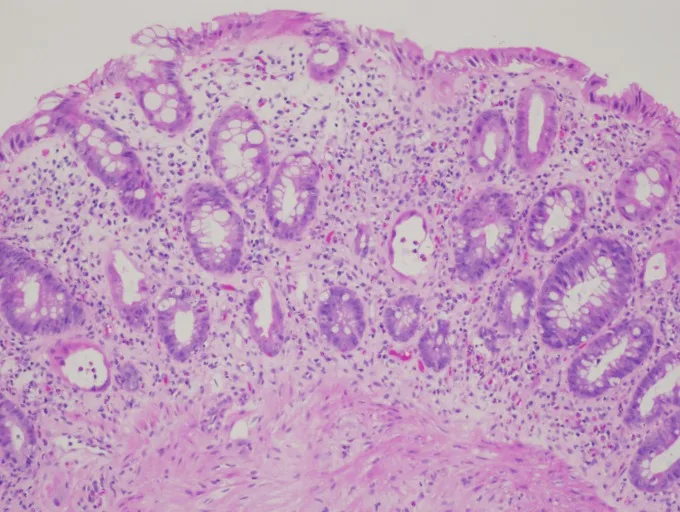 A patient, who was diagnosed with Stage II Colorectal Adenocarcinoma