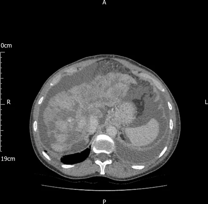A patient, who was diagnosed with Stage IV Breast Cancer