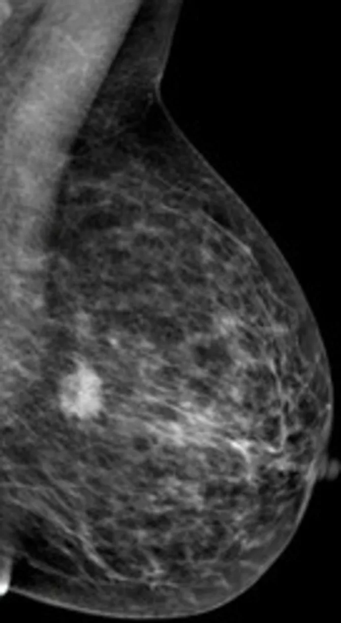 A patient, who was diagnosed with Stage III Invasive Ductal Carcinoma