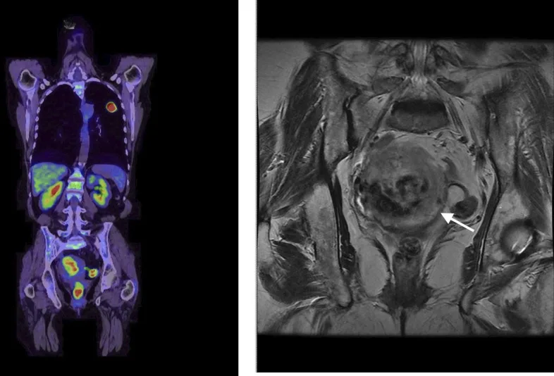 A patient, who was diagnosed with Stage IV Lung Adenocarcinoma