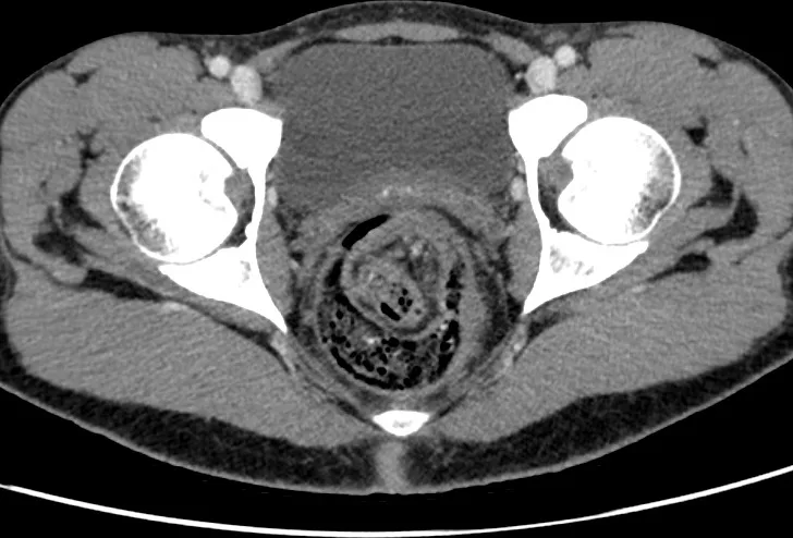 A patient, who was diagnosed with Stage I Colorectal Adenocarcinoma