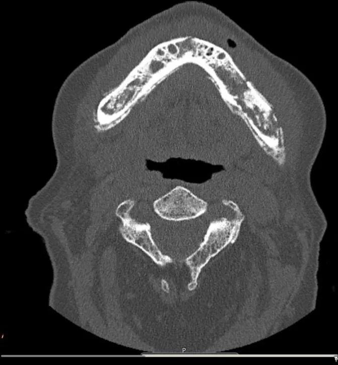 A patient, who was diagnosed with Stage IV Breast Cancer