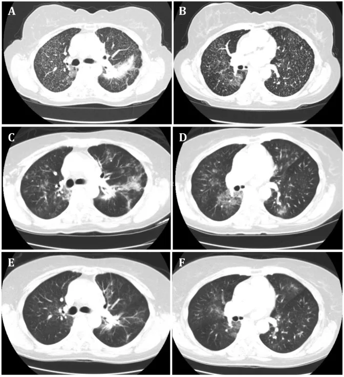A patient, who was diagnosed with Stage IV Lung Adenocarcinoma