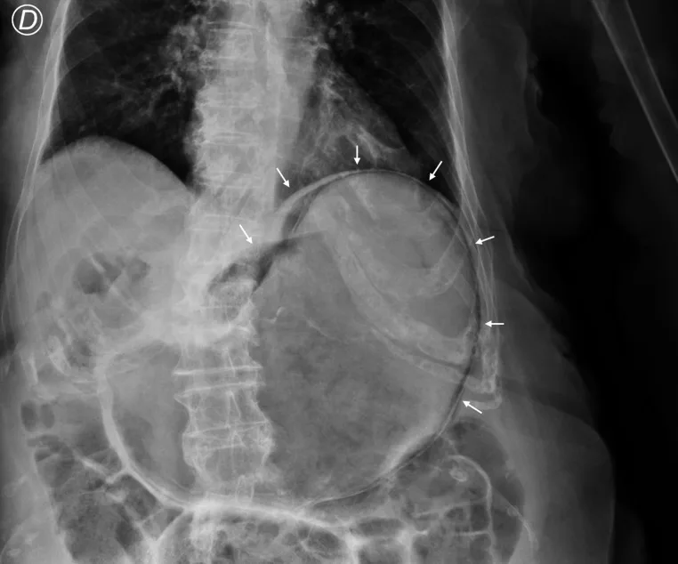A patient, who was diagnosed with Gastric Adenocarcinoma