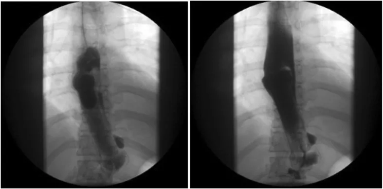 A patient, who was diagnosed with Gastric Cancer