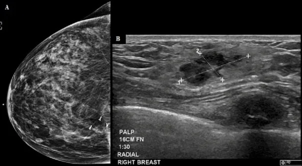A patient, who was diagnosed with Stage I Invasive Lobular Carcinoma