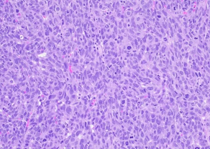 A patient, who was diagnosed with Stage III Invasive Ductal Carcinoma
