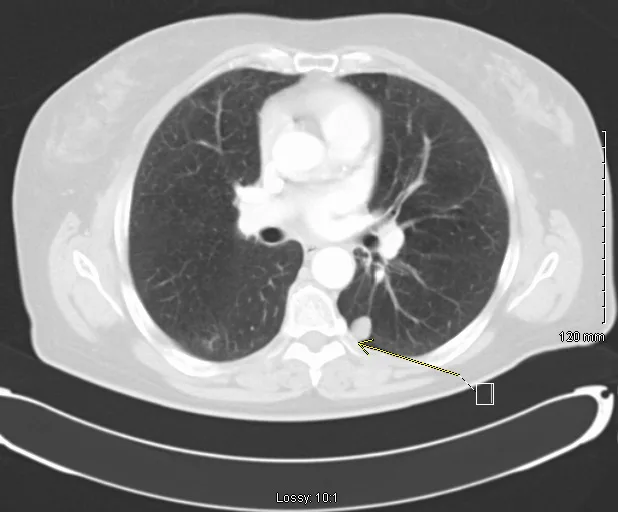 A patient, who was diagnosed with Small Cell Lung Cancer