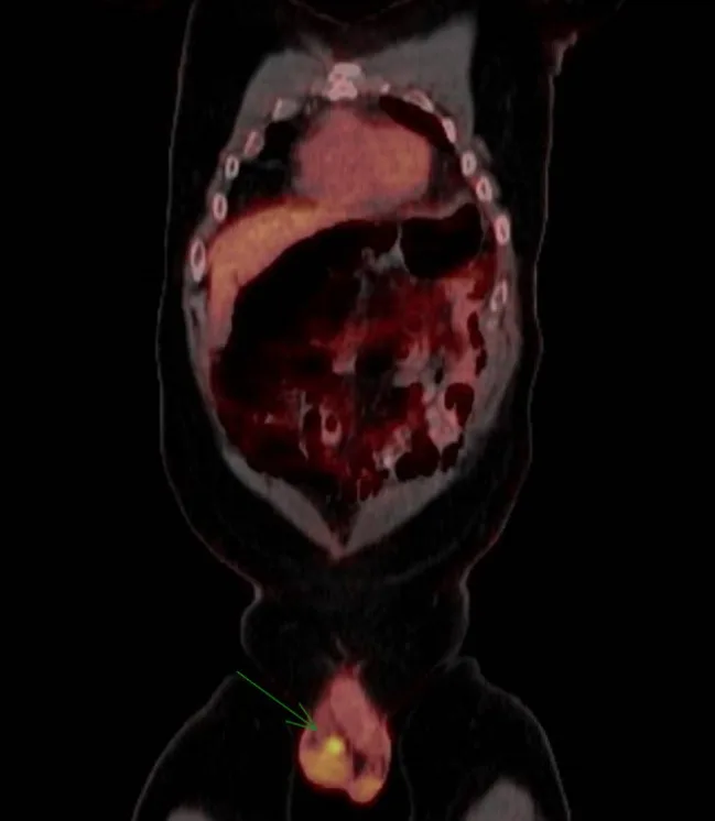 A patient, who was diagnosed with Stage IV Colorectal Adenocarcinoma