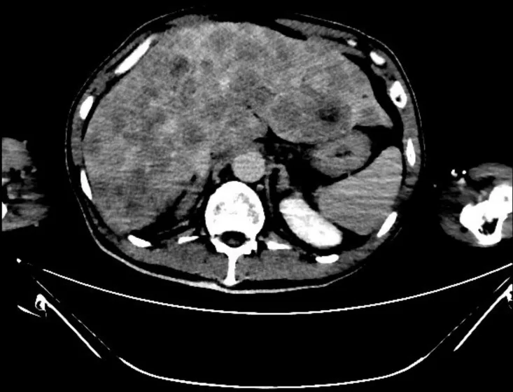 A patient, who was diagnosed with Stage IV Small Cell Lung Cancer