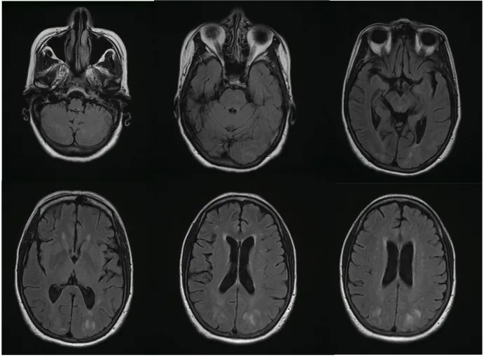 A patient, who was diagnosed with Stage II Lung Squamous Cell Carcinoma