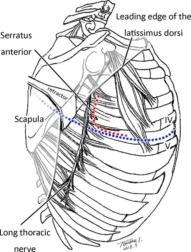 A patient, who was diagnosed with Lung Adenocarcinoma