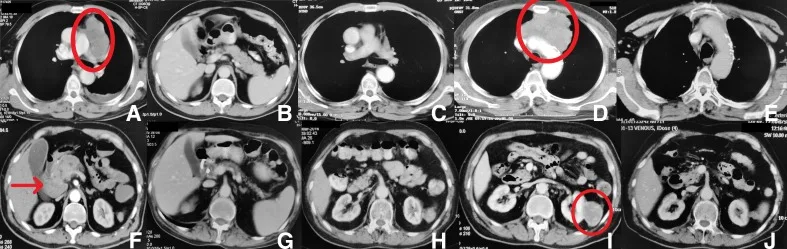 A patient, who was diagnosed with Stage IV Small Cell Lung Cancer