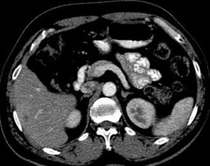 A patient, who was diagnosed with Colorectal Adenocarcinoma