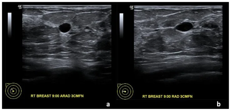 A patient, who was diagnosed with Invasive Ductal Carcinoma