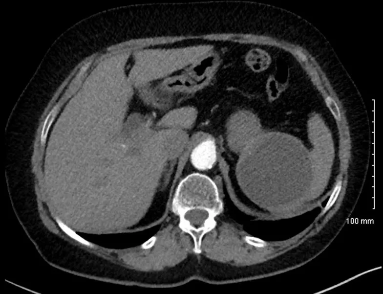 A patient, who was diagnosed with Stage IV Lung Adenocarcinoma