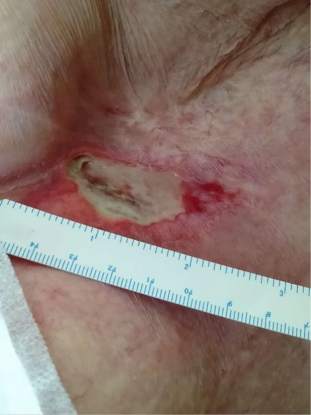 A patient, who was diagnosed with Breast Cancer