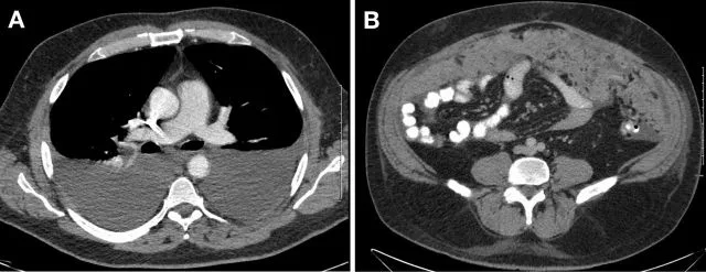 A patient, who was diagnosed with Lung Adenocarcinoma