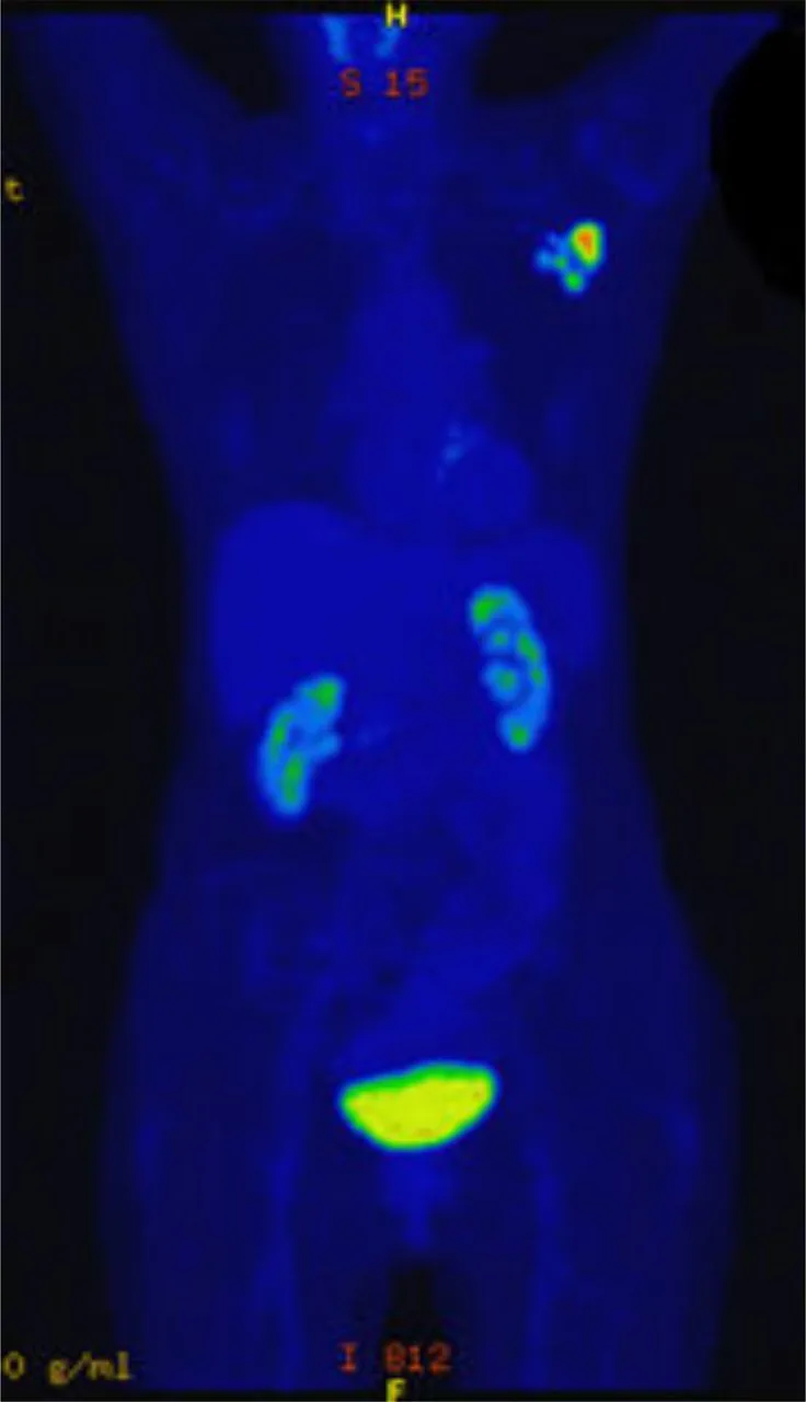A patient, who was diagnosed with Invasive Ductal Carcinoma