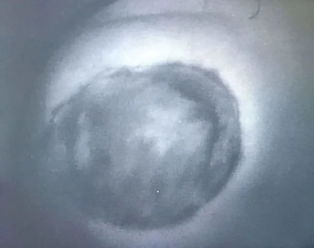 A patient, who was diagnosed with Breast Cancer