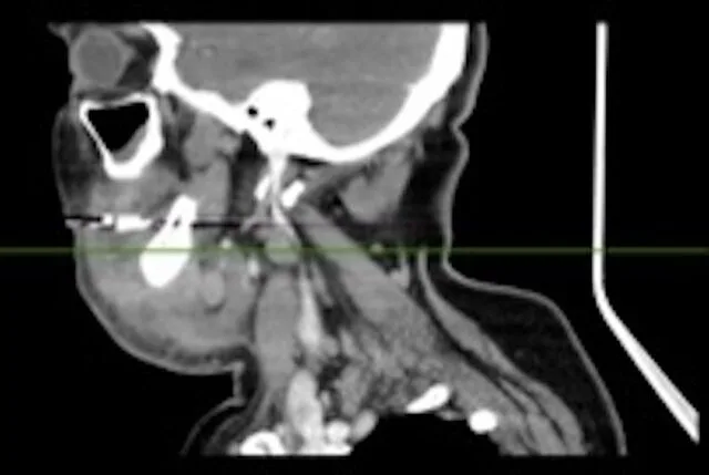 A patient, who was diagnosed with Breast Cancer