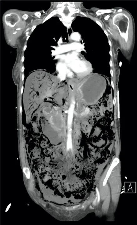 A patient, who was diagnosed with Invasive Ductal Carcinoma