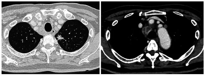 A patient, who was diagnosed with Stage IV Lung Adenocarcinoma