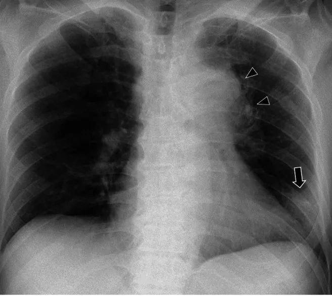 A patient, who was diagnosed with Stage IV Lung Cancer