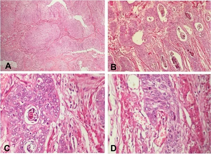 A patient, who was diagnosed with Ovarian Cancer