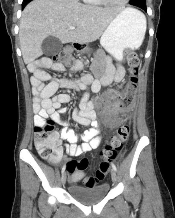 A patient, who was diagnosed with Stage II Colorectal Adenocarcinoma