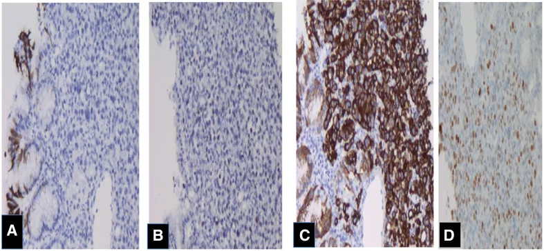 A patient, who was diagnosed with Stage IV Invasive Lobular Carcinoma